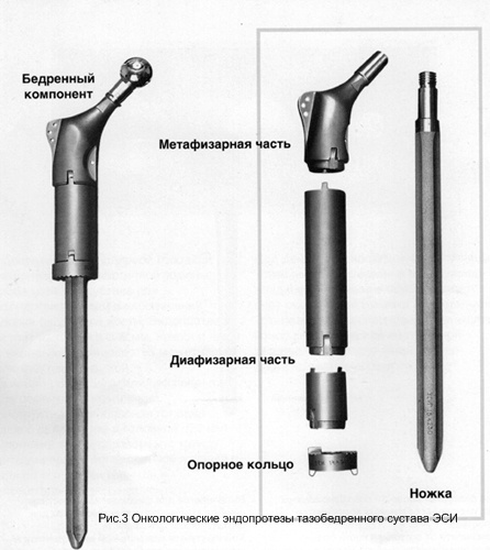 Онкологические эндопротезы тазобедренного ЭСИ